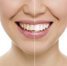 Everything you need to know Cosmetic Tooth Bonding?